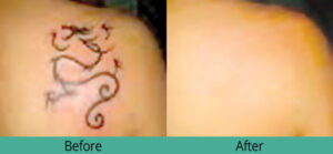 Tattoo laser results