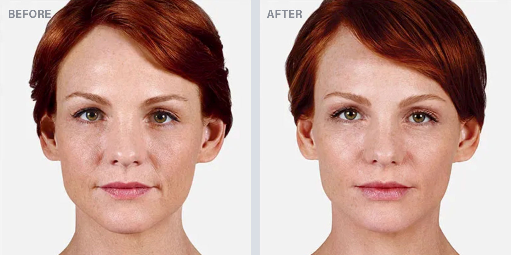 before-after-derma-4